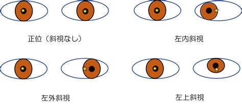 斜視 面相